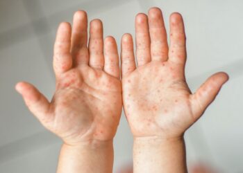 Sumérjase en los casos de HFMD con mejor higiene en medio de Covid-19