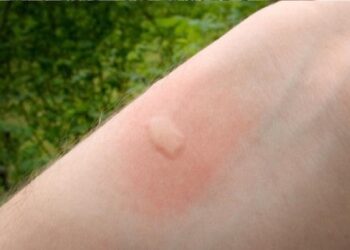 picadura mosquito