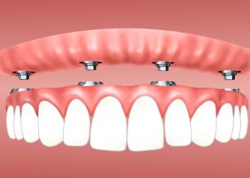 implantes dentales